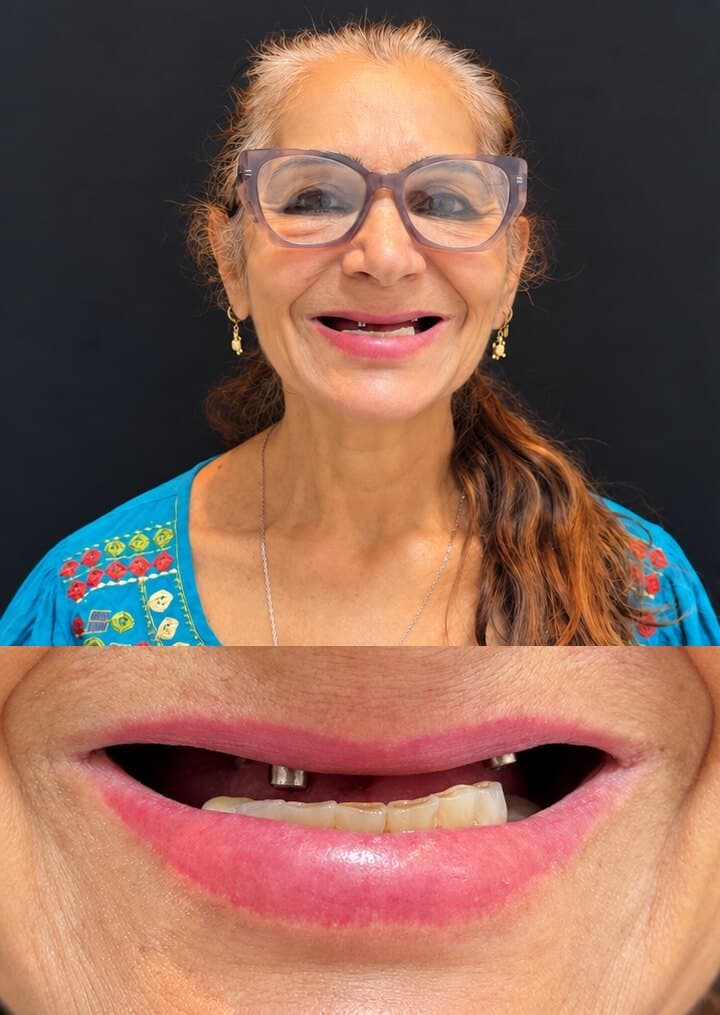 Antes: sorriso de uma paciente com protocolo sobre implantes na Clínica Vita Implantes