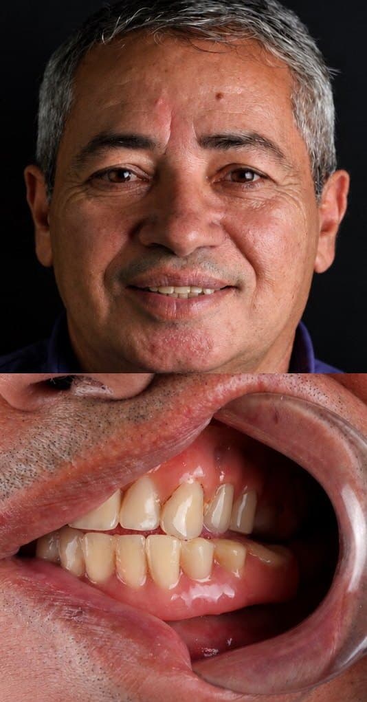 Antes: sorriso de um paciente com lentes de contato dental na Clínica Vita Implantes