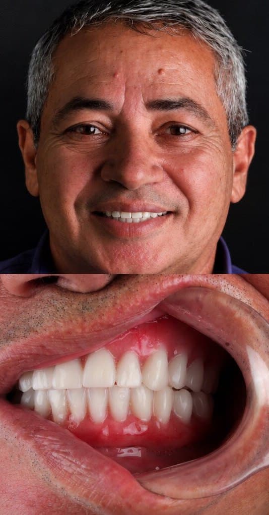 Depois: sorriso de um paciente com lentes de contato dental na Clínica Vita Implantes