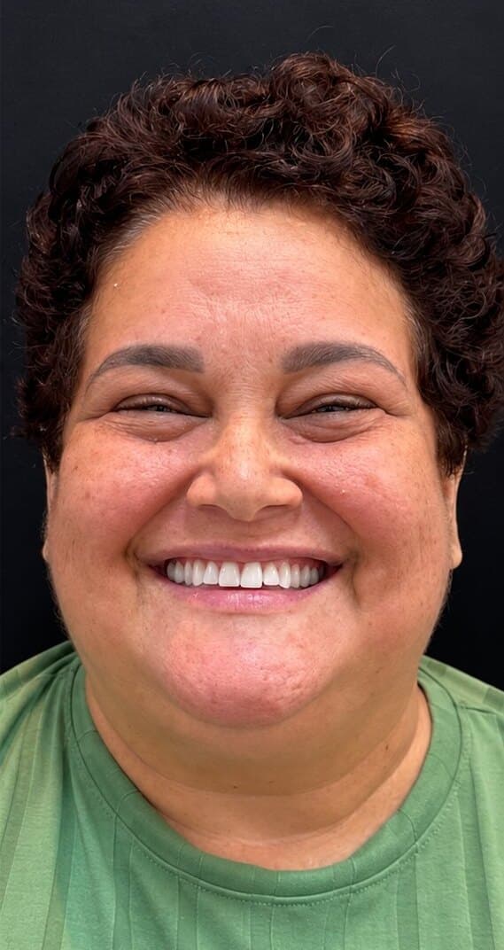 Depois: sorriso de uma paciente com prótese dentária na Clínica Vita Implantes
